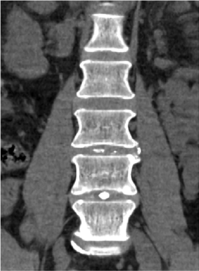 A diagnostic image shows a patented hydrogel in the spine of a patient. 