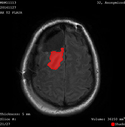 A black-and-white image of an MRI brain scan shows an irregular shaped tumor in red.